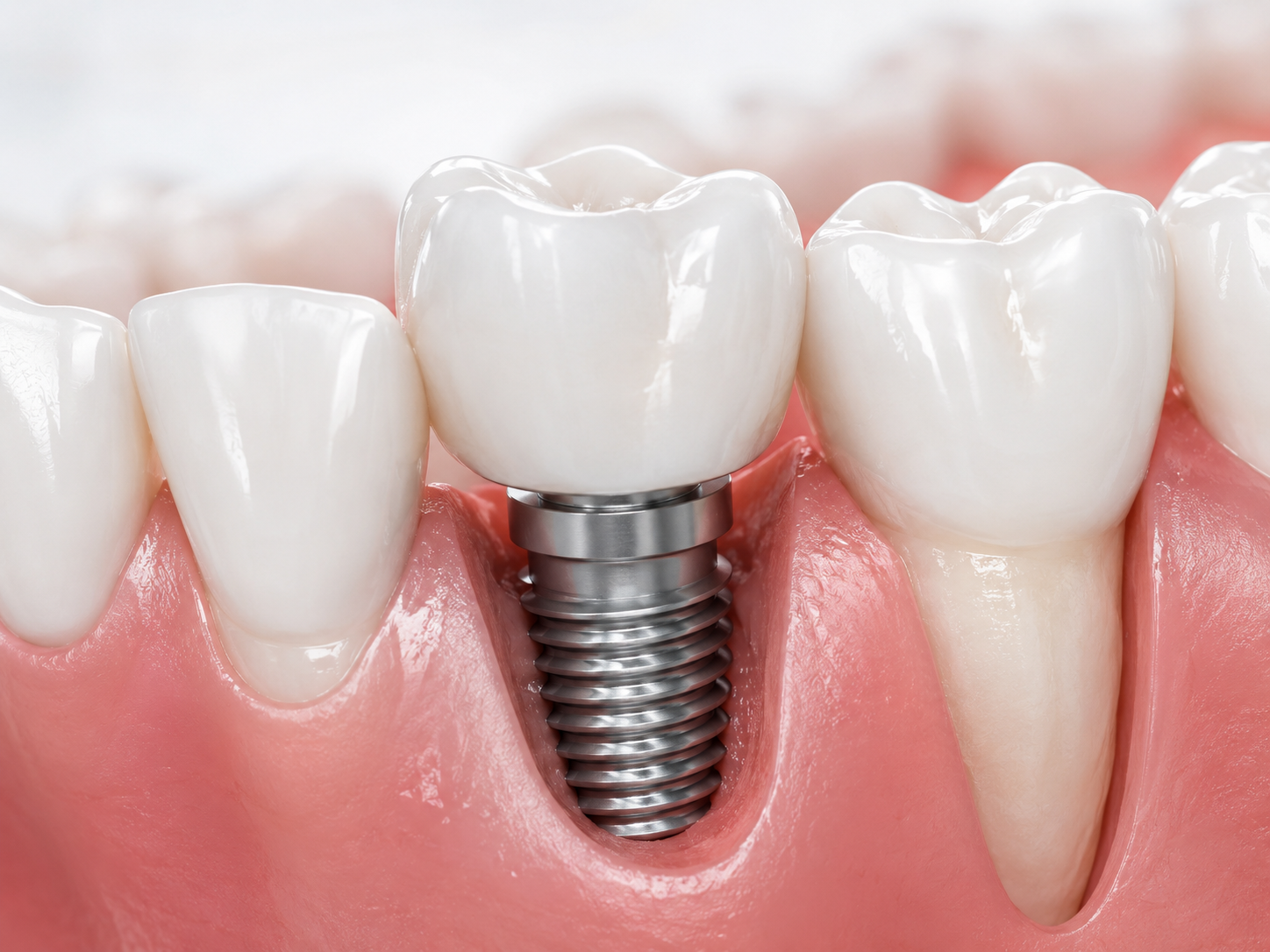 Dental implants
