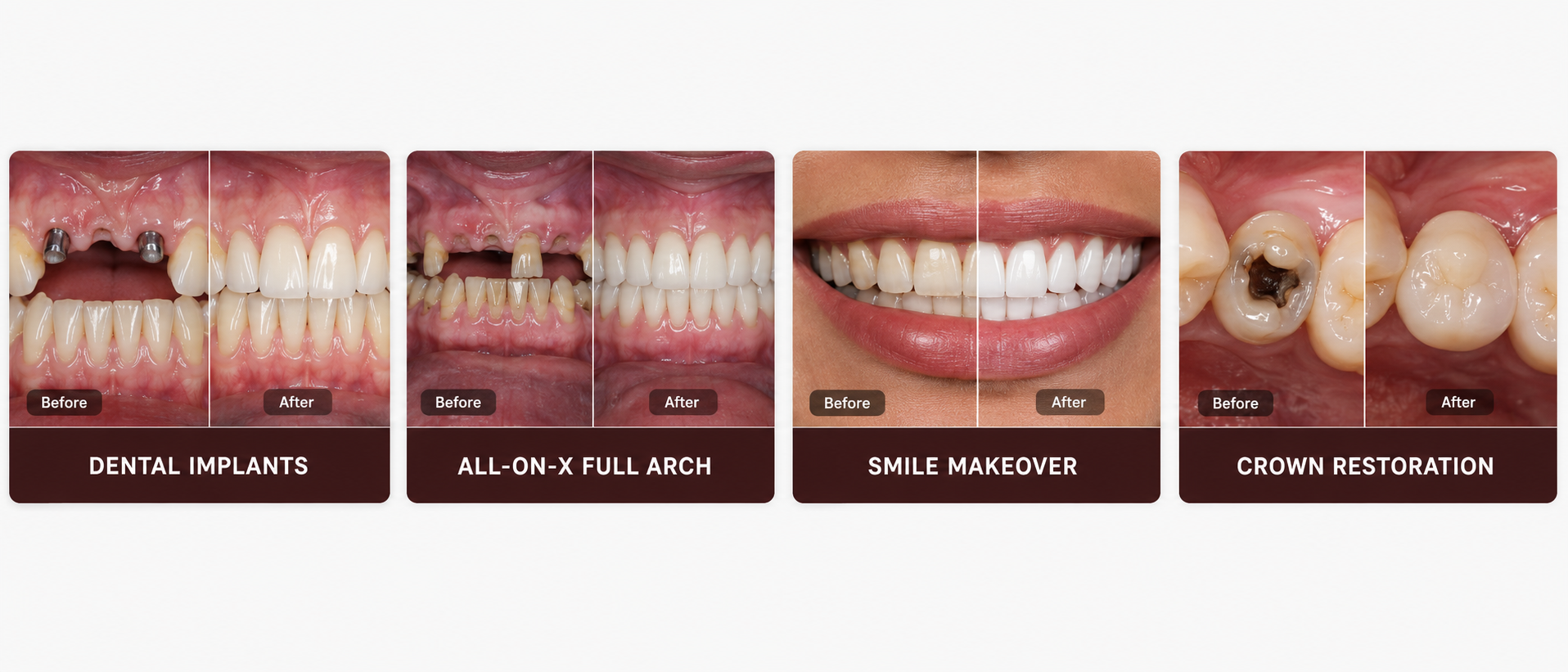 Examples of dental transformations including implants, full arch treatment, smile makeover, and crown restoration