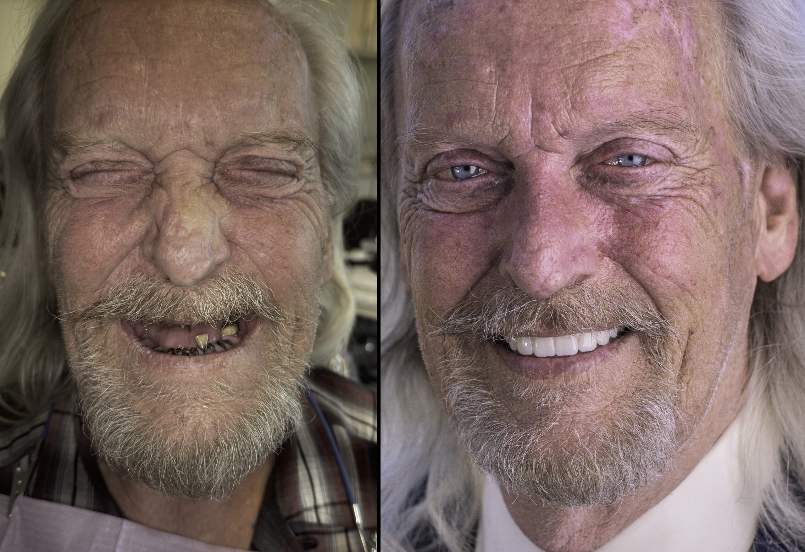 Actual All-on-X patient result at Country Club Dental in Cameron Park