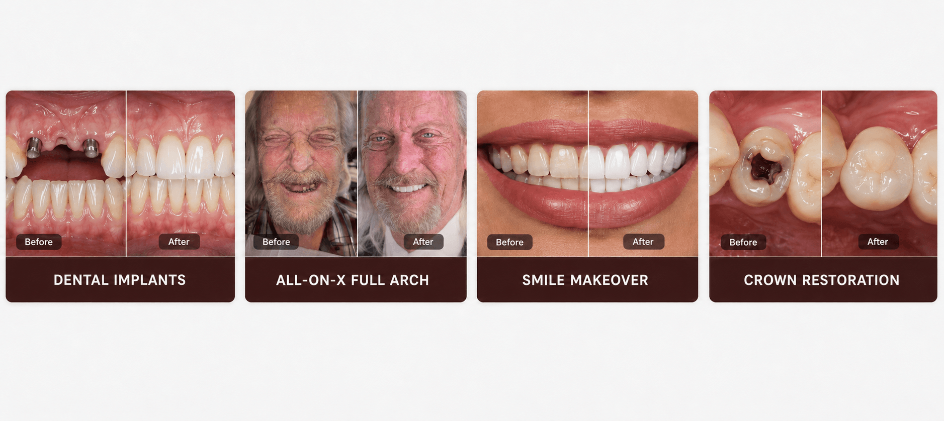 Examples of dental transformations including implants, All-on-X full arch treatment, smile makeover, and crown restoration